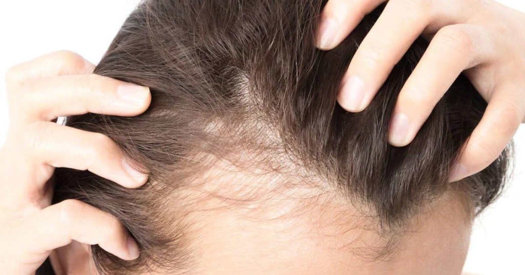 Hair Loss On One Side of Head