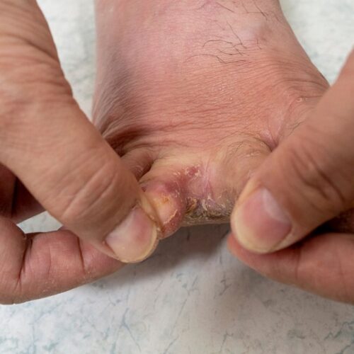 Athlete's Foot Keeps Coming Back
